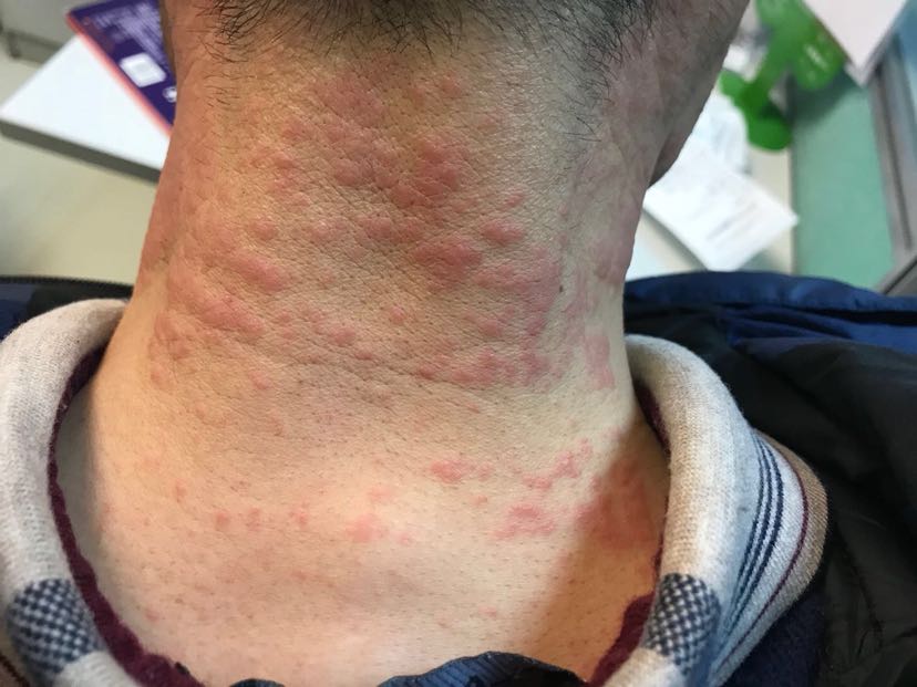 1、膏藥過敏怎么辦？