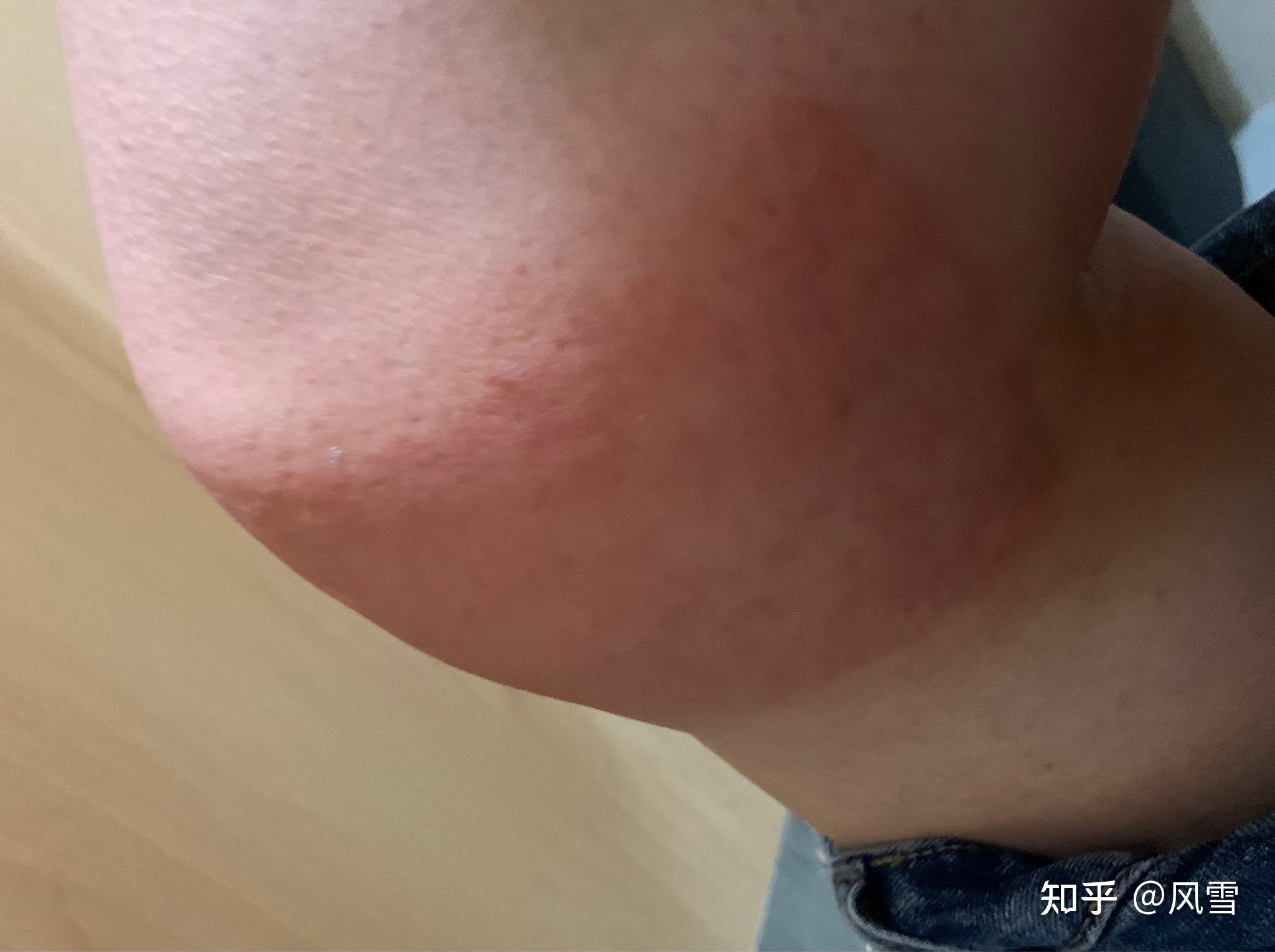 1、貼膏藥過(guò)敏癢紅腫怎么辦？