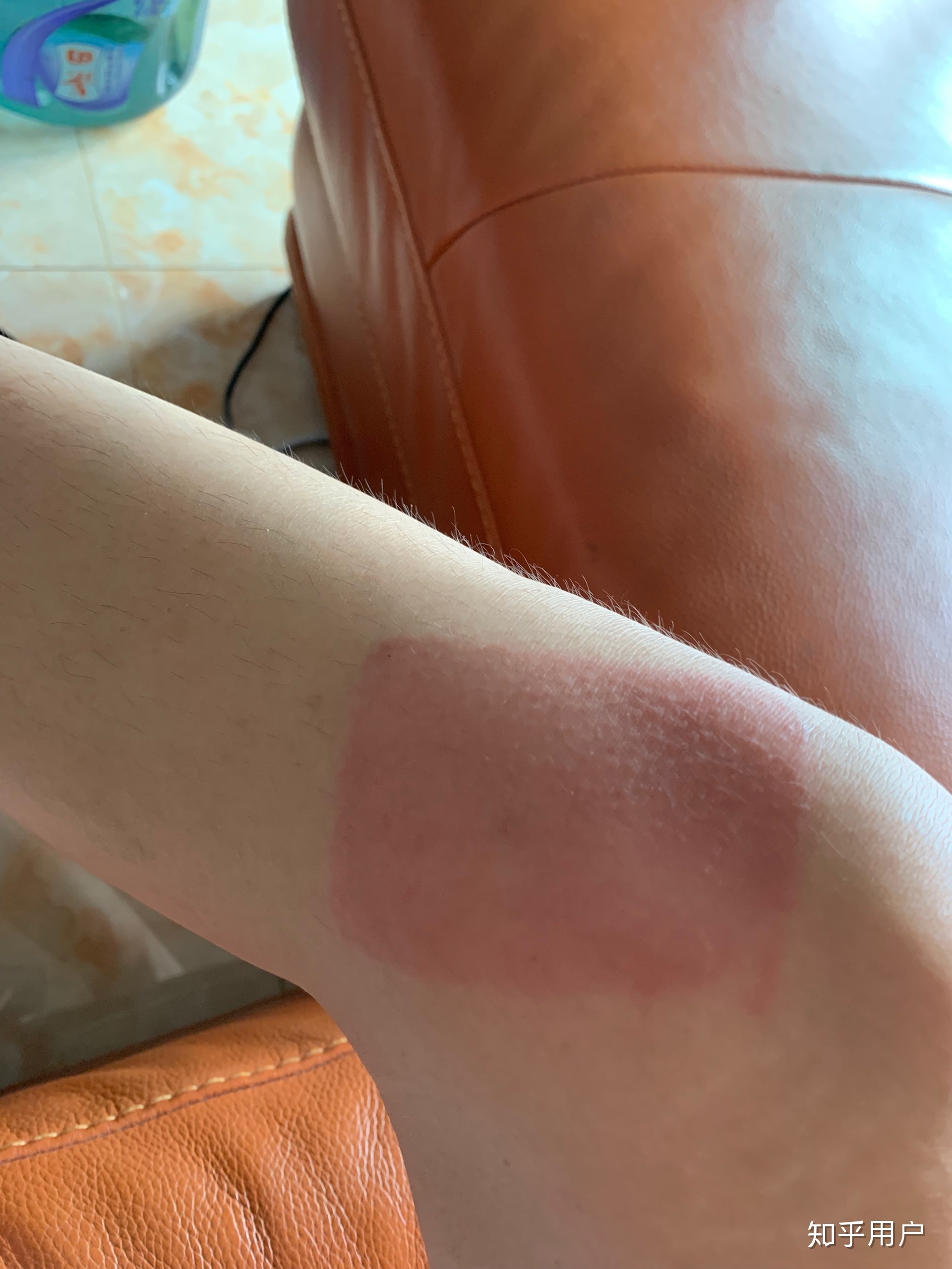 2、貼膏藥的地方有很多紅疙瘩，好不好？